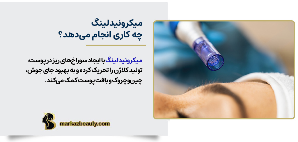 میکرونیدلینگ چه کاری انجام می‌دهد؟ | مرکز بیوتی