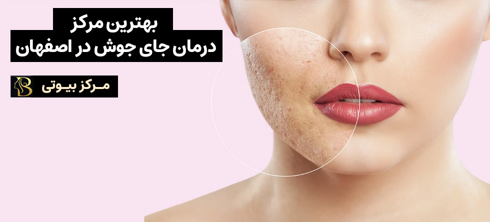 درمان جای جوش اصفهان | مرکز بیوتی