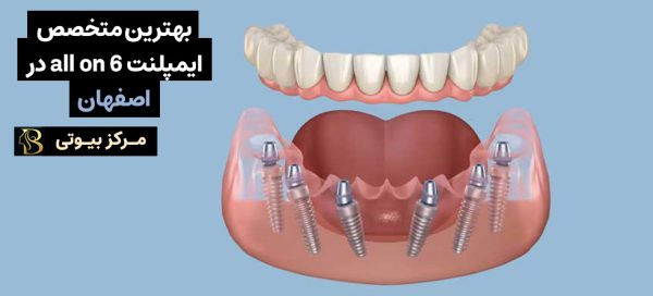 ایمپلنت دندان all on 6 اصفهان | مرکز بیوتی